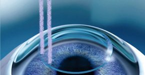    Chirurgie Réfractive au Laser                 Video